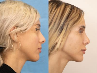 Rhinoplasty Before & After Gallery - Patient 402723 - Image 1