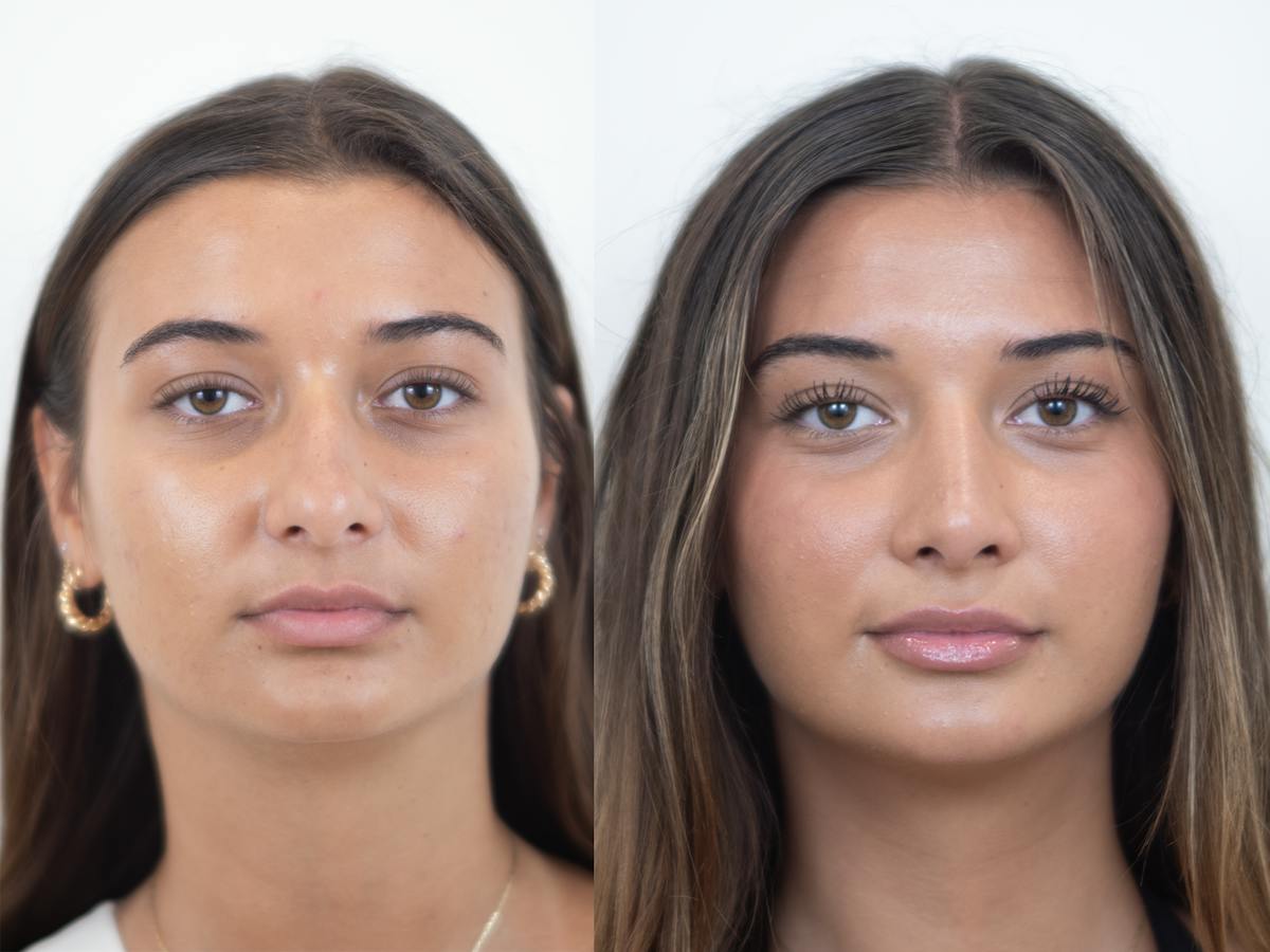Rhinoplasty Before & After Gallery - Patient 331166 - Image 2