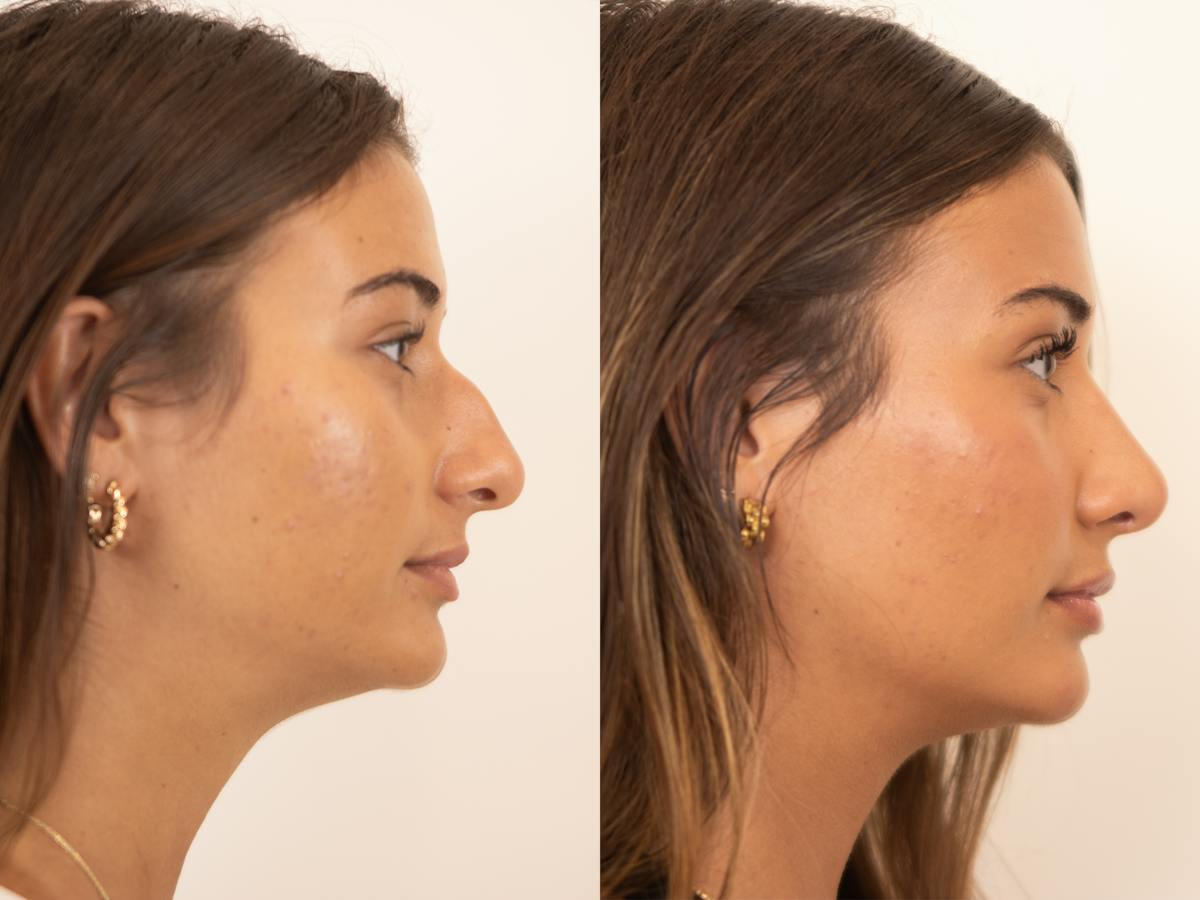 Rhinoplasty Before & After Gallery - Patient 331166 - Image 1