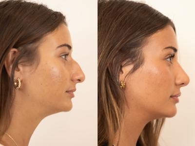 Rhinoplasty Before & After Gallery - Patient 331166 - Image 1