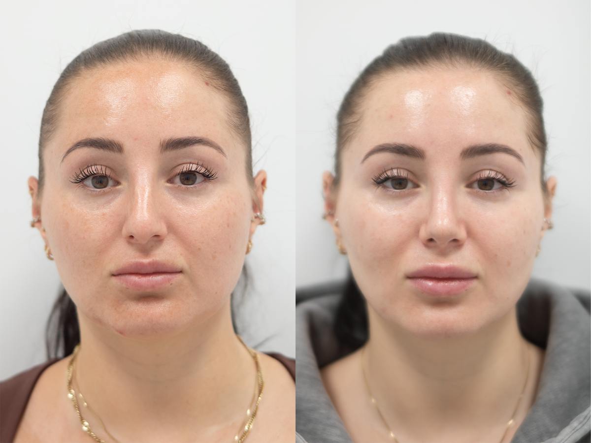 Rhinoplasty Before & After Gallery - Patient 288550 - Image 2