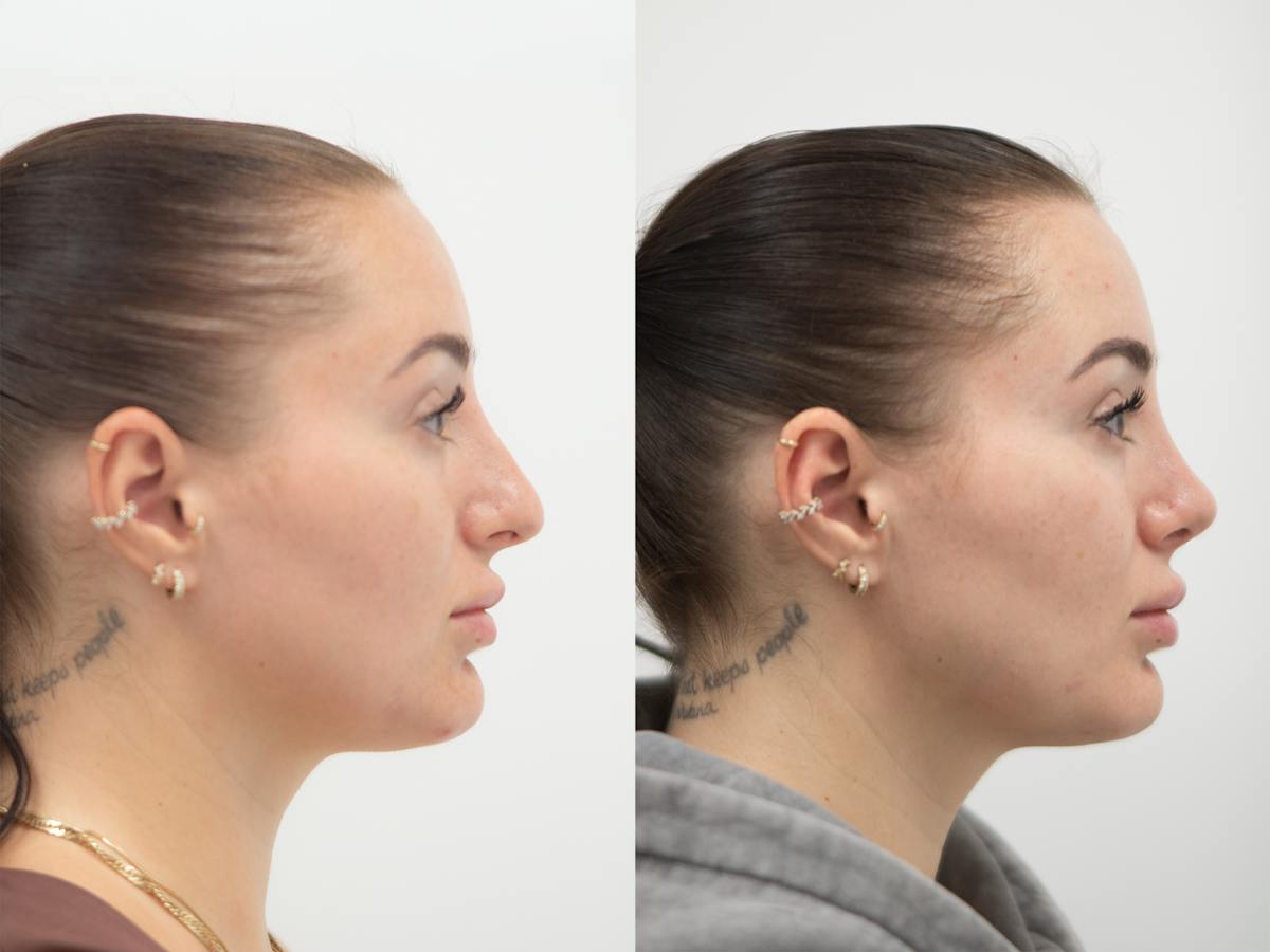 Rhinoplasty Before & After Gallery - Patient 288550 - Image 1
