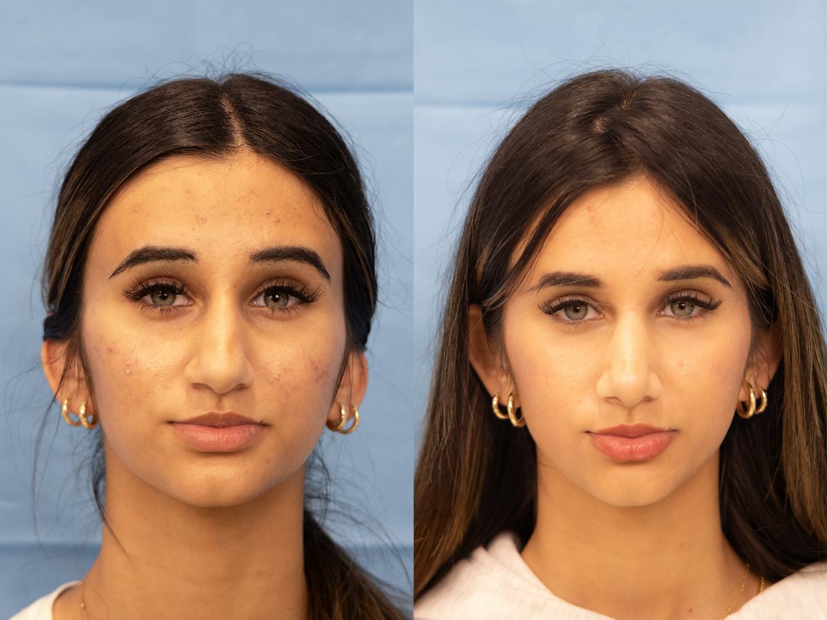 Rhinoplasty Before & After Gallery - Patient 173782 - Image 2