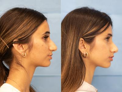 Rhinoplasty Before & After Gallery - Patient 173782 - Image 1