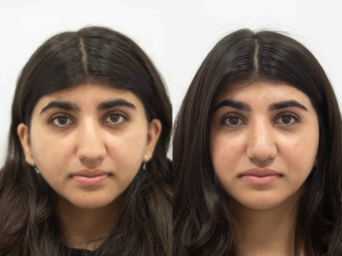 Rhinoplasty Before & After Gallery - Patient 291045 - Image 2