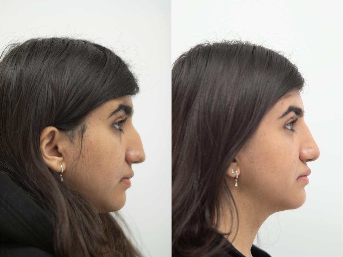 Rhinoplasty Before & After Gallery - Patient 291045 - Image 1