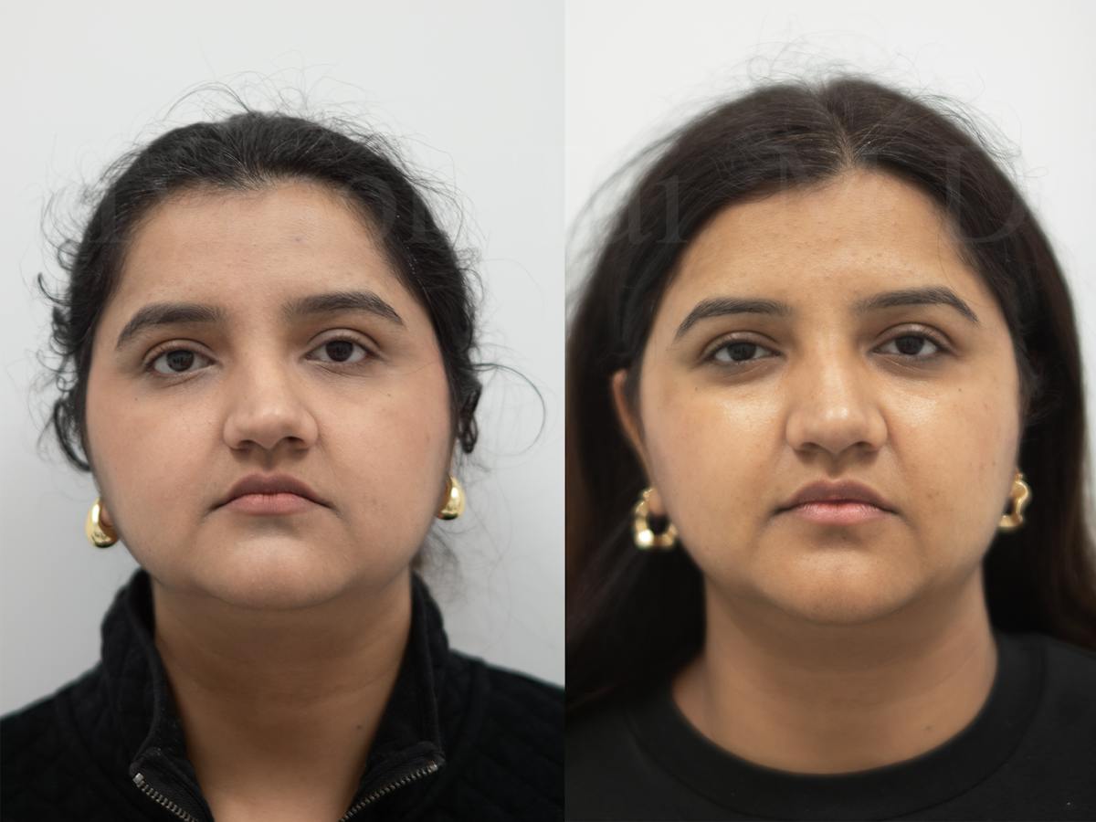 Rhinoplasty Before & After Gallery - Patient 115192 - Image 2