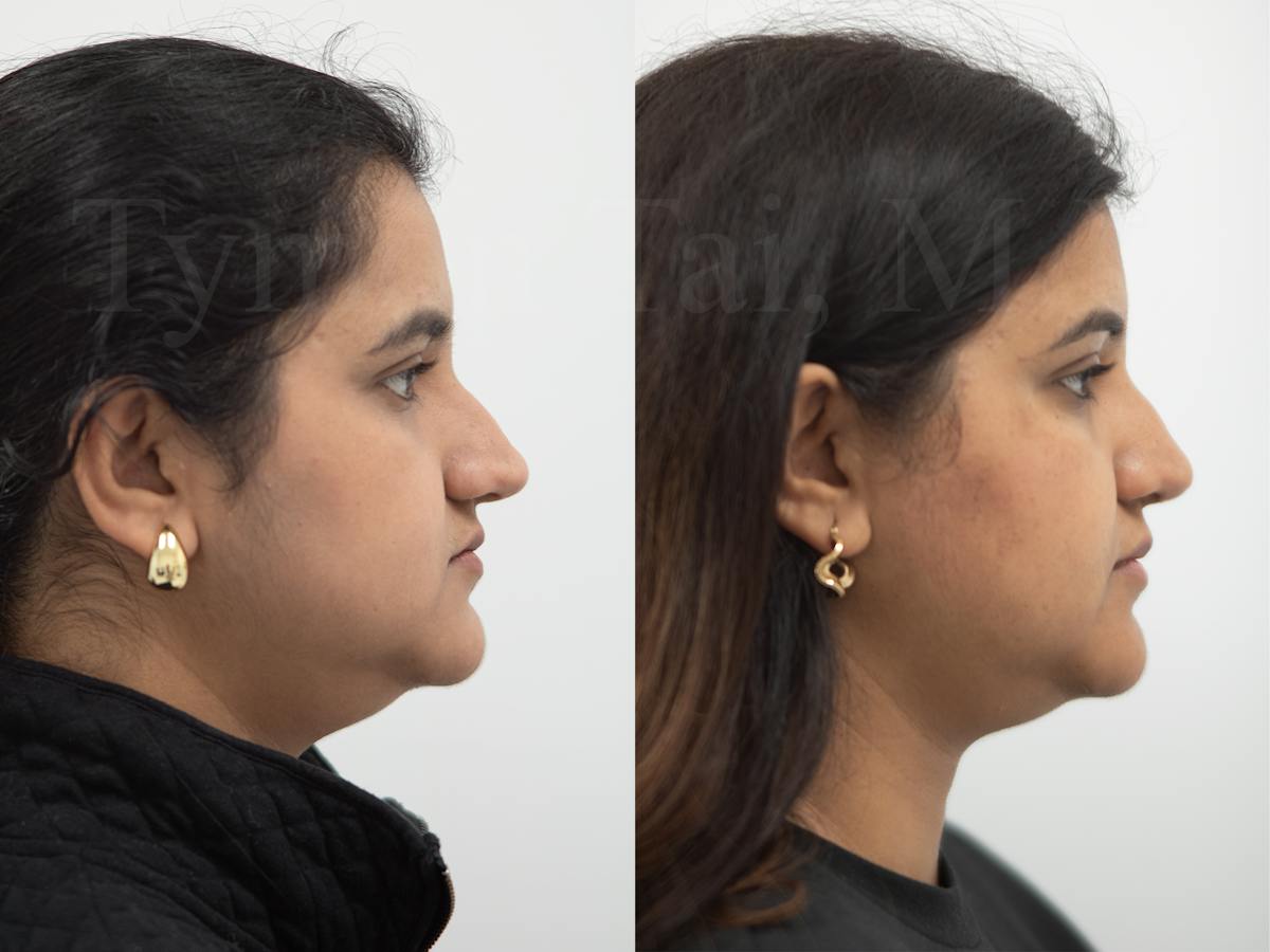 Rhinoplasty Before & After Gallery - Patient 115192 - Image 1