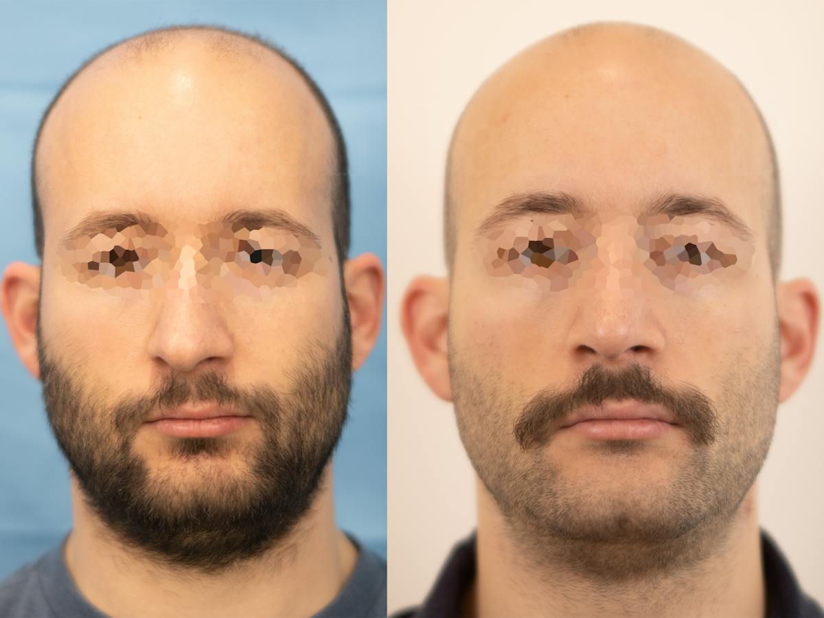 Rhinoplasty Before & After Gallery - Patient 335033 - Image 2