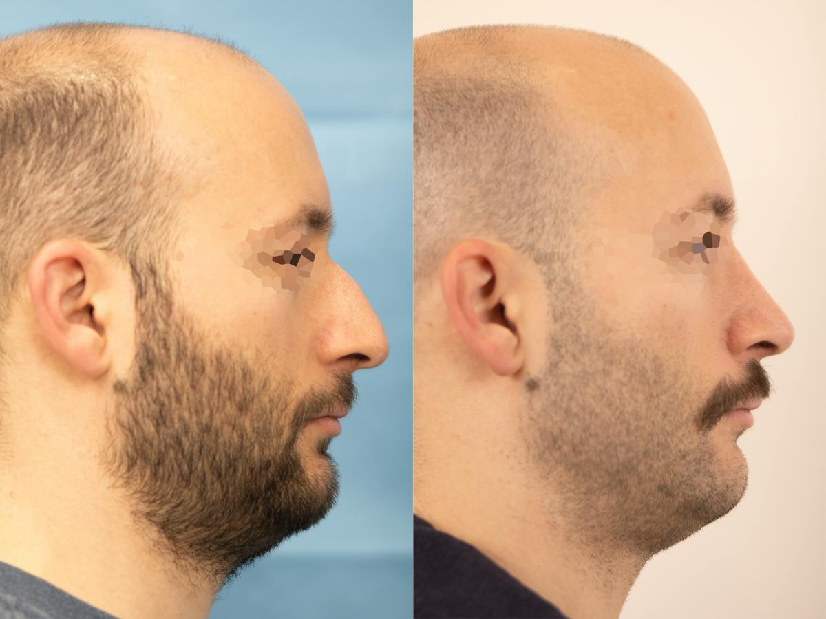 Rhinoplasty Before & After Gallery - Patient 335033 - Image 1