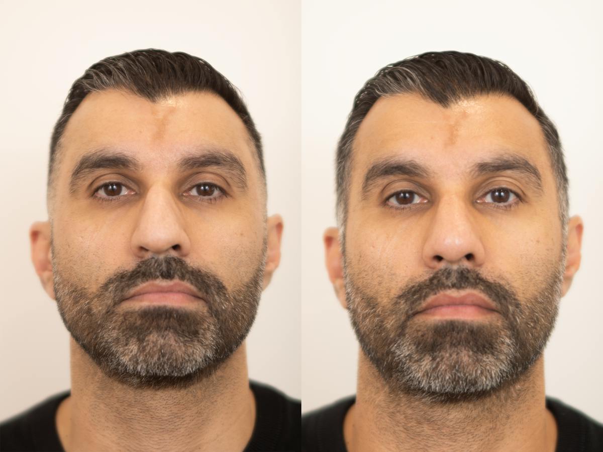 Rhinoplasty Before & After Gallery - Patient 420942 - Image 2