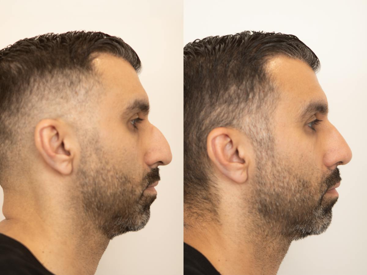 Rhinoplasty Before & After Gallery - Patient 420942 - Image 1