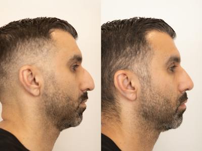 Rhinoplasty Before & After Gallery - Patient 420942 - Image 1