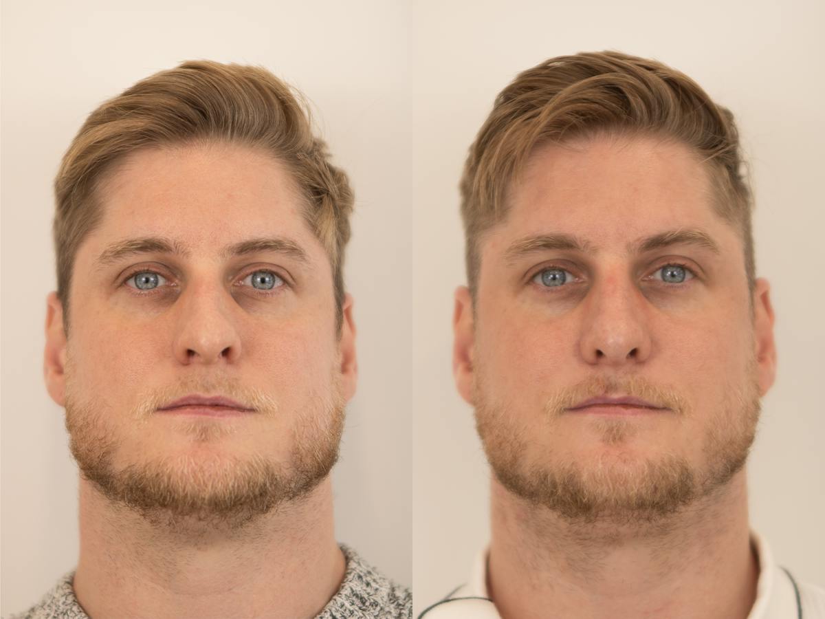 Rhinoplasty Before & After Gallery - Patient 318407 - Image 2