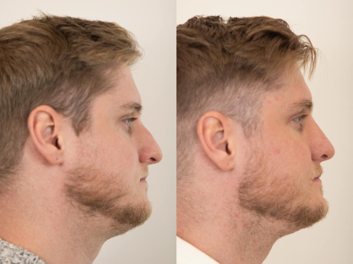 Rhinoplasty Before & After Gallery - Patient 318407 - Image 1