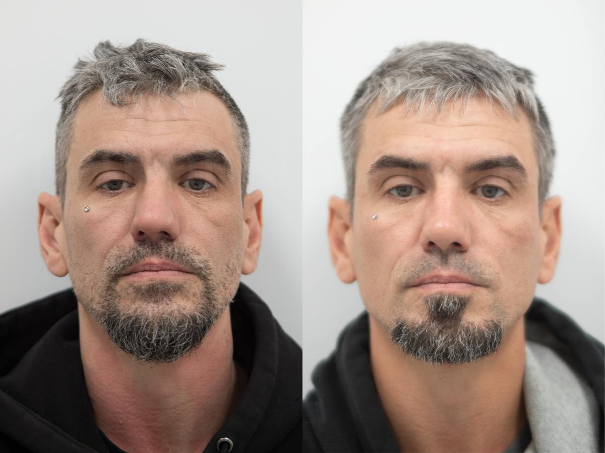 Rhinoplasty Before & After Gallery - Patient 279142 - Image 2