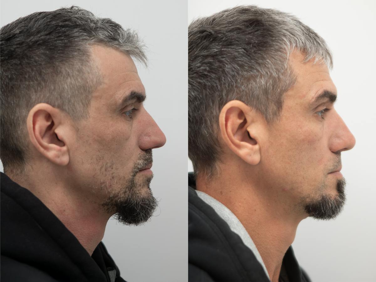 Rhinoplasty Before & After Gallery - Patient 279142 - Image 1
