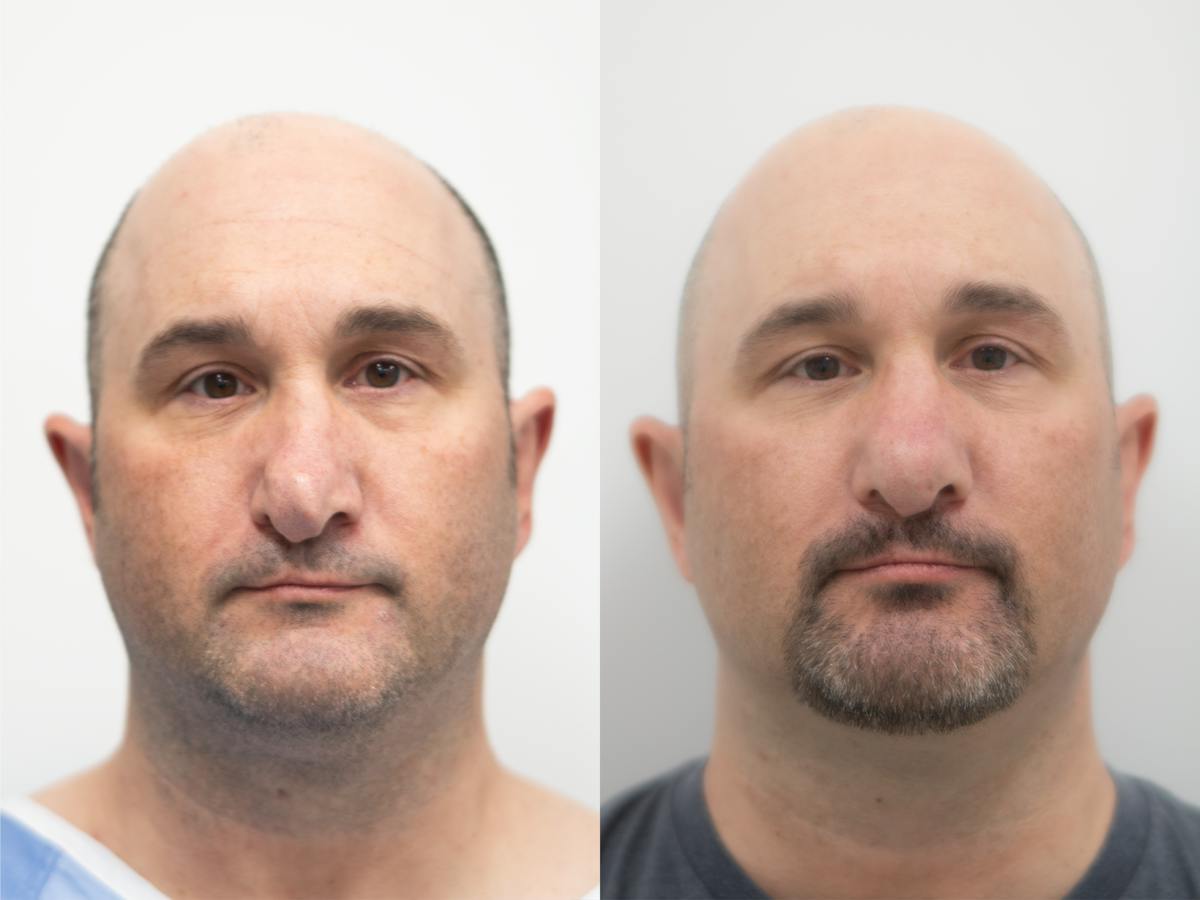 Rhinoplasty Before & After Gallery - Patient 790841 - Image 2