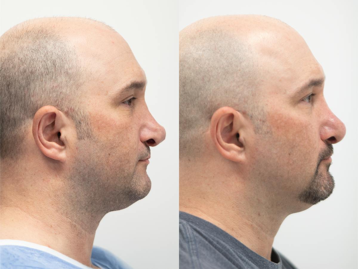 Rhinoplasty Before & After Gallery - Patient 790841 - Image 1