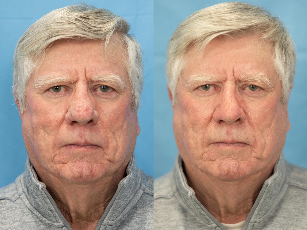 Rhinoplasty Before & After Gallery - Patient 317670 - Image 2