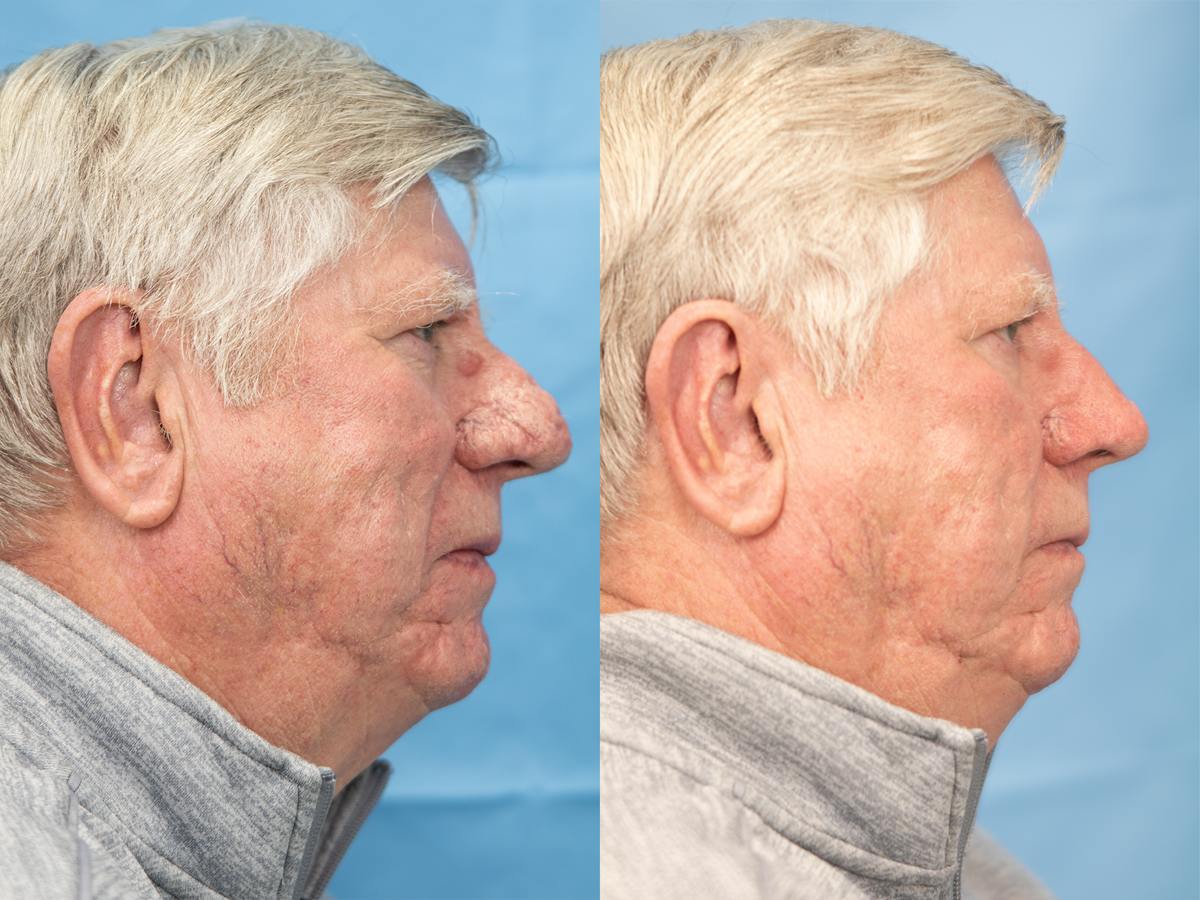 Rhinoplasty Before & After Gallery - Patient 317670 - Image 1