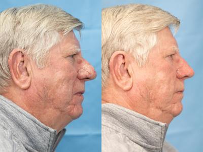 Rhinoplasty Before & After Gallery - Patient 317670 - Image 1