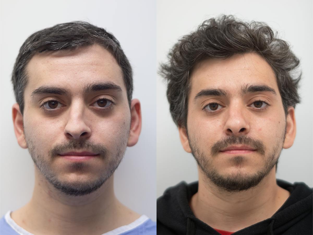Rhinoplasty Before & After Gallery - Patient 333422 - Image 2