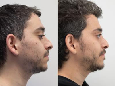Rhinoplasty Before & After Gallery - Patient 333422 - Image 1