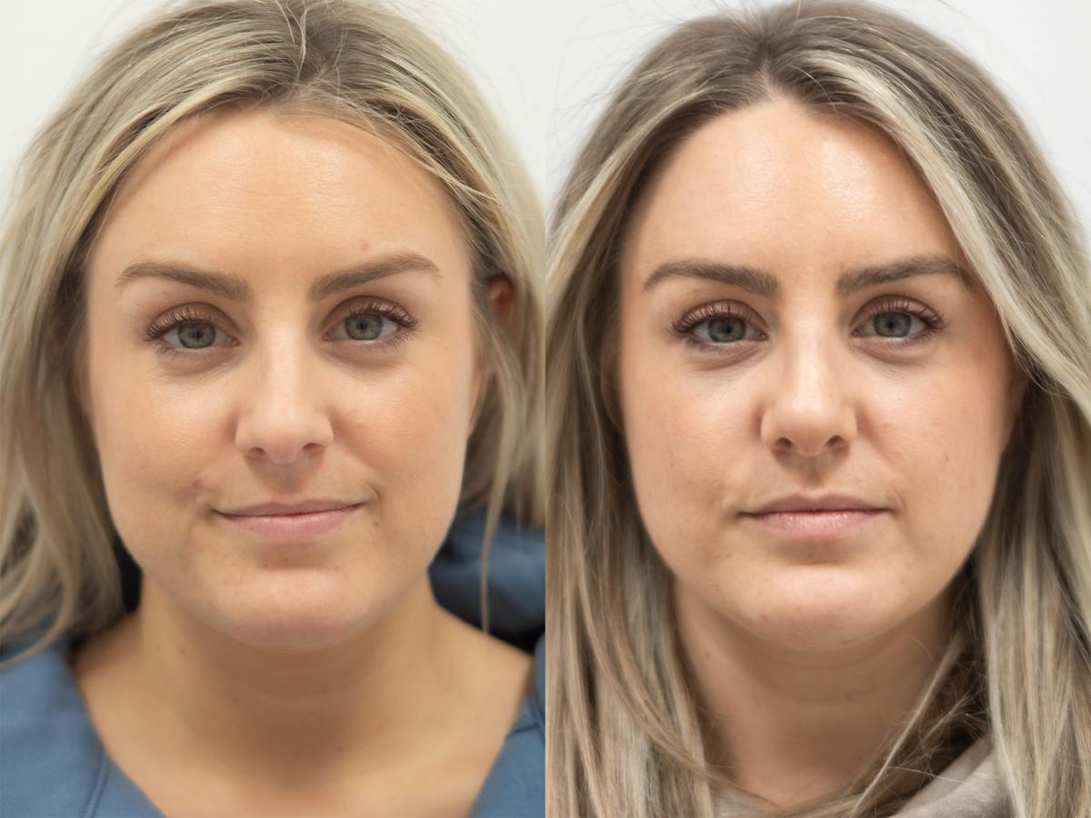 Rhinoplasty Before & After Gallery - Patient 229965 - Image 2