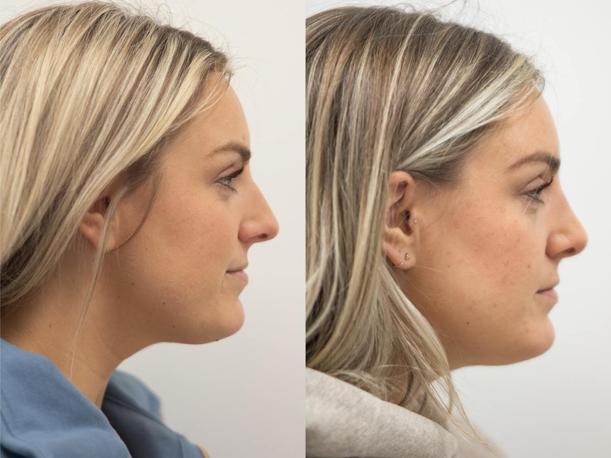 Rhinoplasty Before & After Gallery - Patient 229965 - Image 1