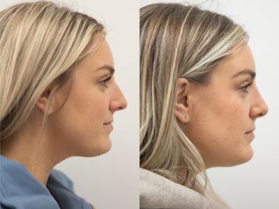 Rhinoplasty Before & After Gallery - Patient 229965 - Image 1