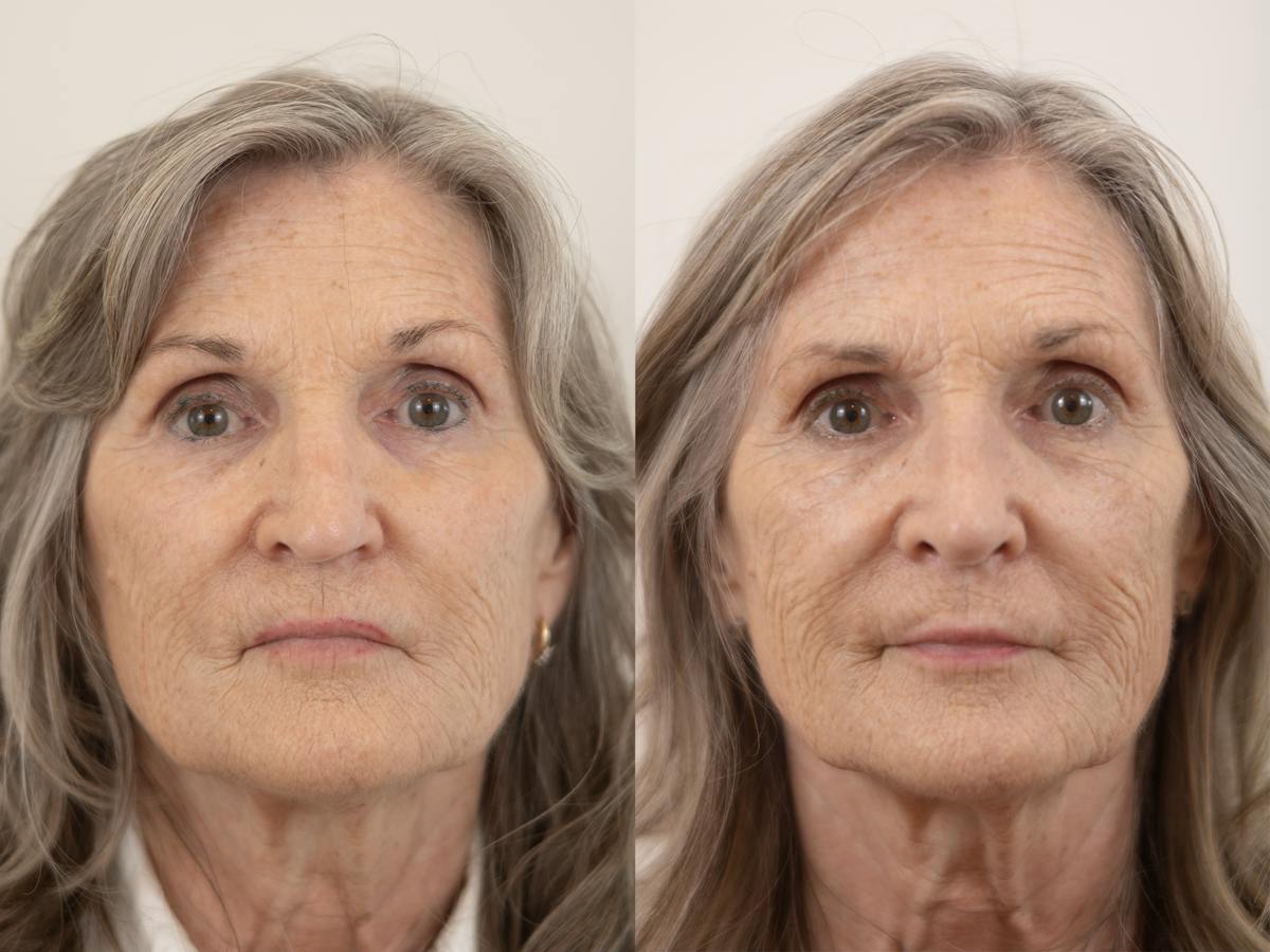Rhinoplasty Before & After Gallery - Patient 219594 - Image 2