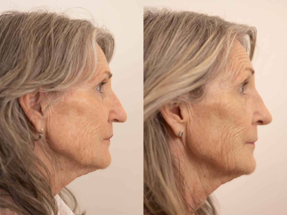 Rhinoplasty Before & After Gallery - Patient 219594 - Image 1