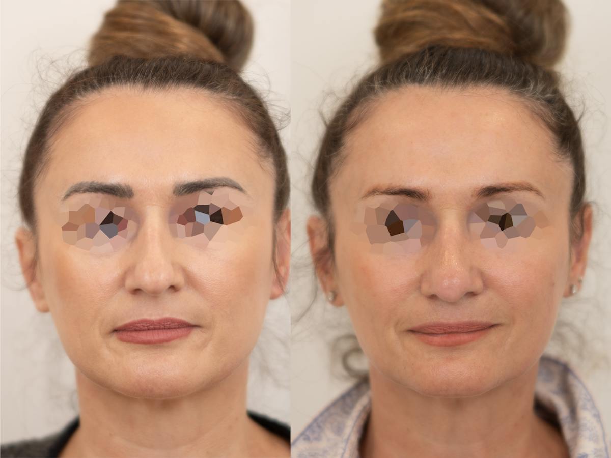 Rhinoplasty Before & After Gallery - Patient 265141 - Image 2