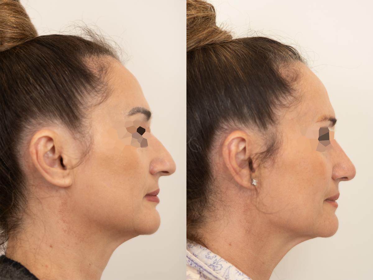 Rhinoplasty Before & After Gallery - Patient 265141 - Image 1