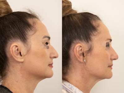 Rhinoplasty Before & After Gallery - Patient 265141 - Image 1
