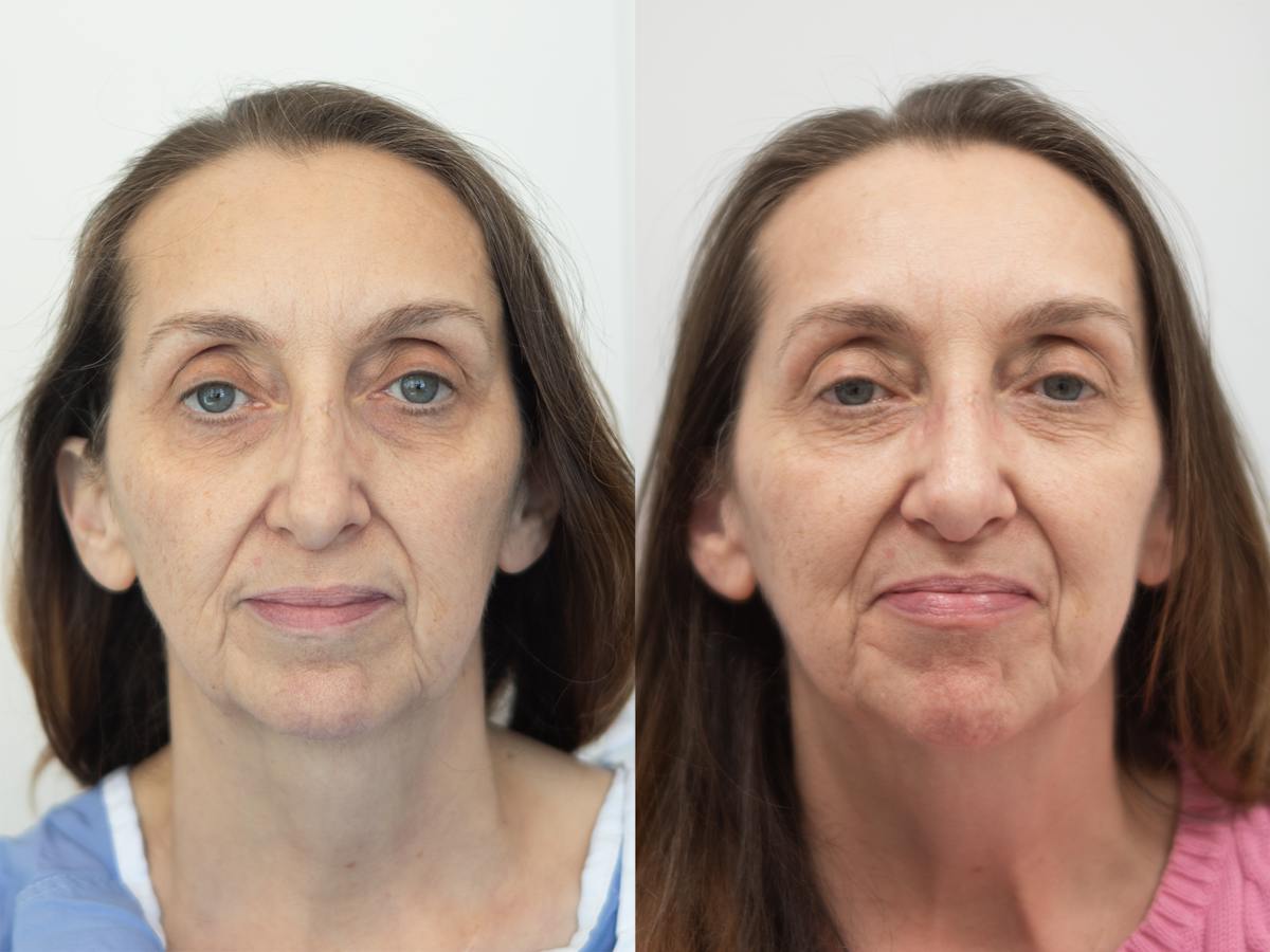 Rhinoplasty Before & After Gallery - Patient 945461 - Image 2