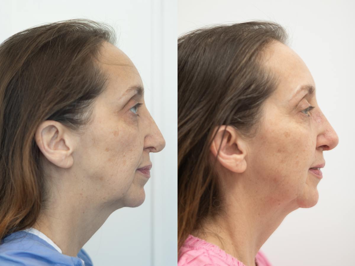 Rhinoplasty Before & After Gallery - Patient 945461 - Image 1