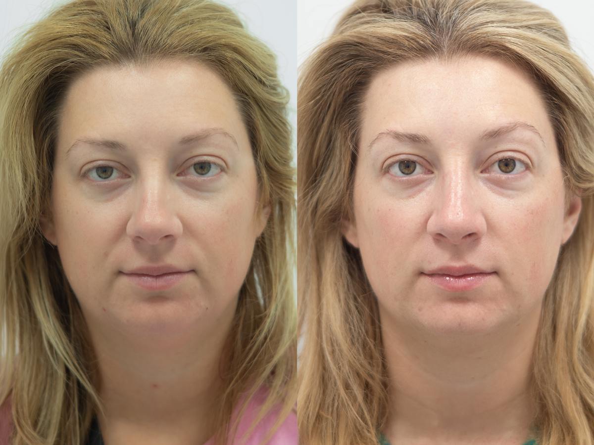 Rhinoplasty Before & After Gallery - Patient 171339 - Image 2