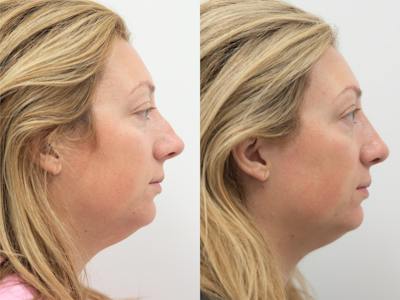 Rhinoplasty Before & After Gallery - Patient 171339 - Image 1