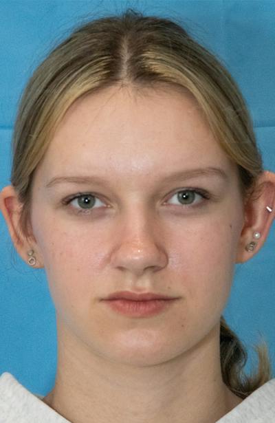 Minor Surgery Before & After Gallery - Patient 114299 - Image 1