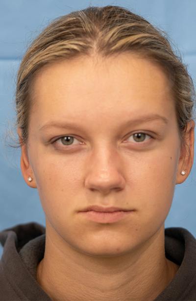 Minor Surgery Before & After Gallery - Patient 114299 - Image 2