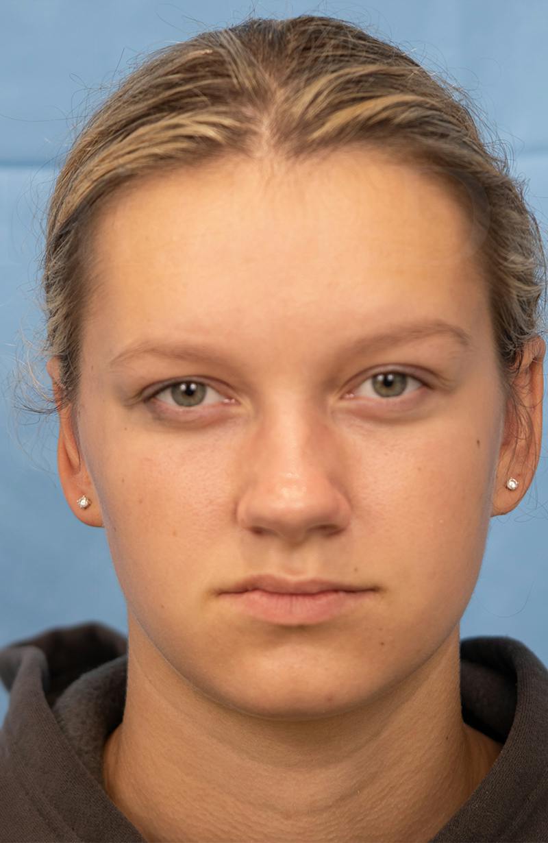 Minor Surgery Before & After Gallery - Patient 114299 - Image 2