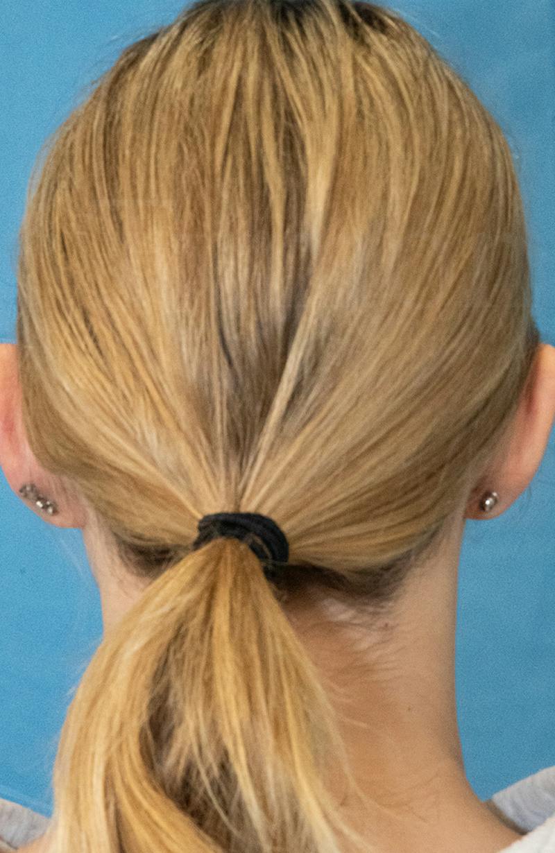 Minor Surgery Before & After Gallery - Patient 114299 - Image 3