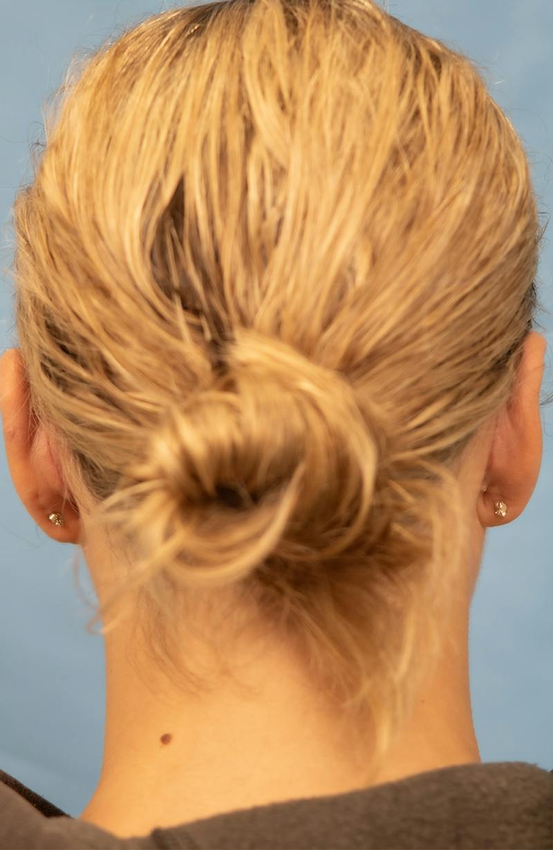 Minor Surgery Before & After Gallery - Patient 114299 - Image 4
