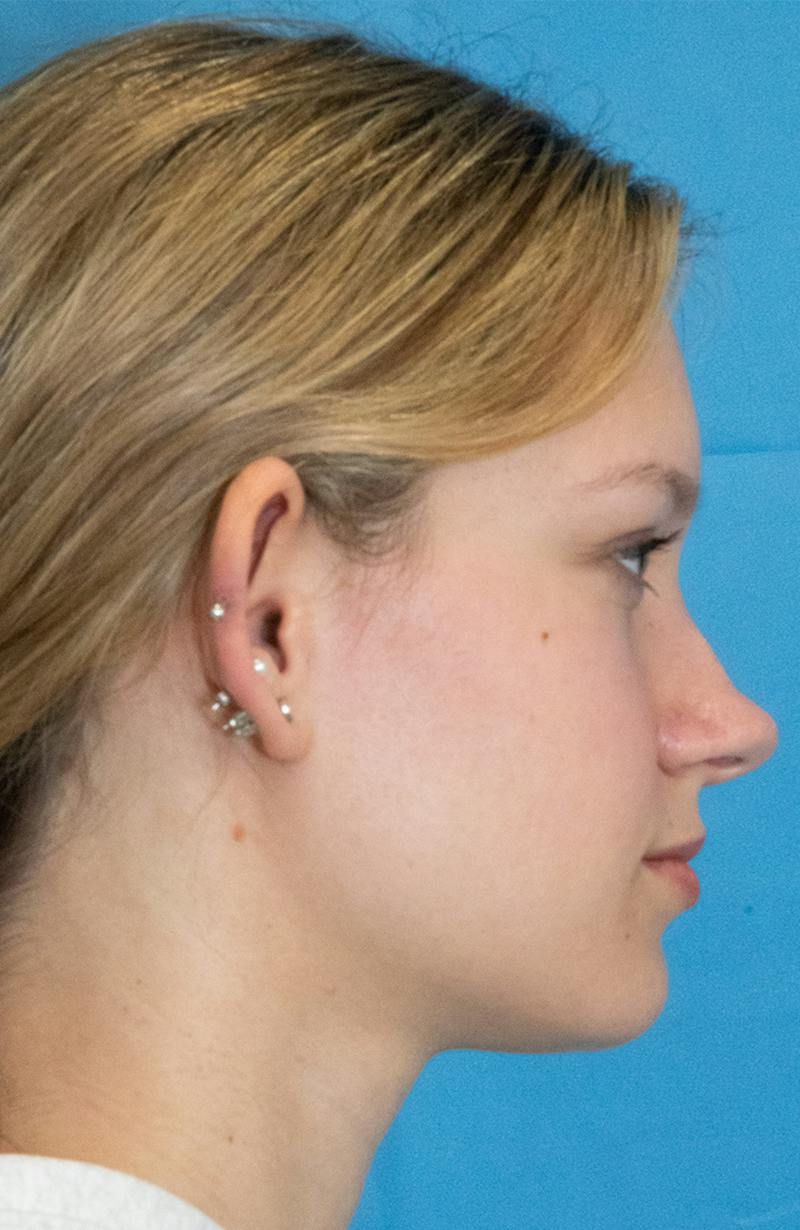 Minor Surgery Before & After Gallery - Patient 114299 - Image 5