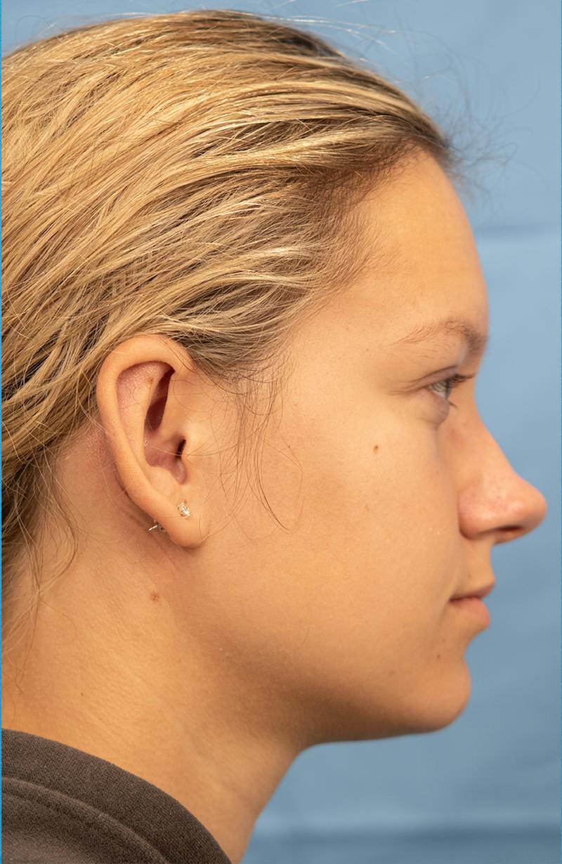 Minor Surgery Before & After Gallery - Patient 114299 - Image 6
