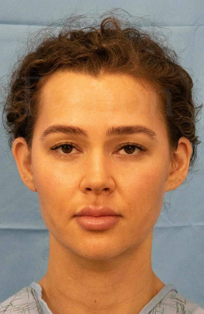 Minor Surgery Before & After Gallery - Patient 281714 - Image 1