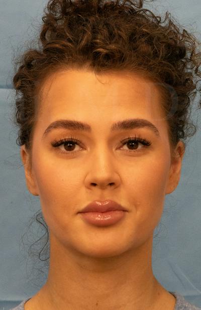 Minor Surgery Before & After Gallery - Patient 281714 - Image 2