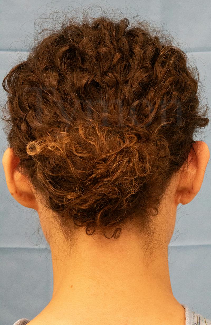 Minor Surgery Before & After Gallery - Patient 281714 - Image 3